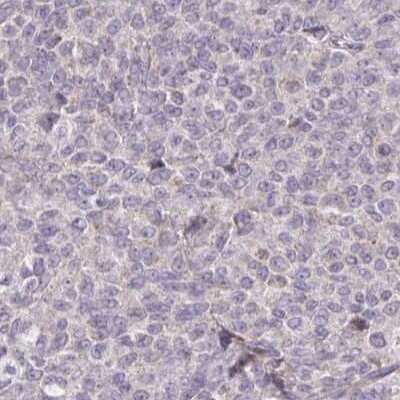 Immunohistochemistry-Paraffin: Brorin/VWC2 Antibody [NBP2-33745] - Staining of breast cancer.