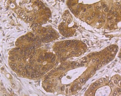 Immunohistochemistry-Paraffin: Villin 1 Antibody (JU34-75) [NBP2-75707] - Analysis of paraffin-embedded human colon cancer tissue using anti-Villin1 antibody. Counter stained with hematoxylin.