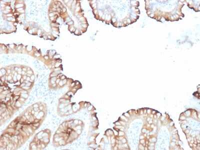Immunohistochemistry-Paraffin: Villin 1 Antibody (VIL1/1314 + VIL1/2376) - Azide and BSA Free [NBP3-08919] - Formalin-fixed, paraffin-embedded human Colon Carcinoma stained with Villin 1 Mouse Monoclonal Antibody (VIL1/1314 + VIL1/2376).