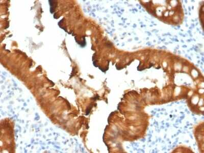 Immunohistochemistry-Paraffin: Villin 1 Antibody (VIL1/2376) - Azide and BSA Free [NBP3-08928] - Formalin-fixed, paraffin-embedded human Colon Carcinoma stained with Villin 1 Mouse Monoclonal Antibody (VIL1/2376).