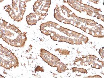 Immunohistochemistry-Paraffin: Villin 1 Antibody (rVIL1/1325) - Azide and BSA Free [NBP2-79943] - Formalin-fixed, paraffin-embedded human Small Intestinal Carcinoma stained with Villin-Monospecific Recombinant Mouse Monoclonal Antibody (rVIL1/1325).