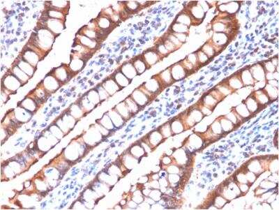 Immunohistochemistry-Paraffin: Villin 1 Antibody (rVIL1/1325) - Azide and BSA Free [NBP2-79943] - Formalin-fixed, paraffin-embedded human Small Intestinal Carcinoma stained with Villin-Monospecific Recombinant Mouse Monoclonal Antibody (rVIL1/1325).
