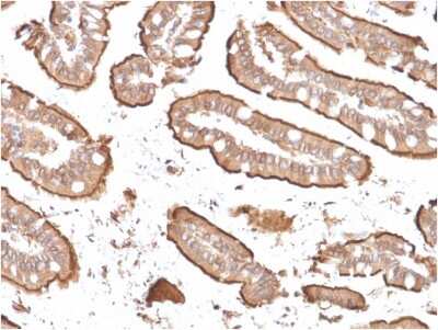 Immunohistochemistry-Paraffin: Villin 1 Antibody (rVIL1/1325) [NBP2-79809] - Formalin-fixed, paraffin-embedded human Small Intestinal Carcinoma stained with Villin 1 Antibody (rVIL1/1325).