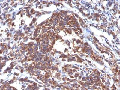 Immunohistochemistry-Paraffin: Vimentin Antibody (LN-6) - IHC-Prediluted [NBP2-48190] - Human Melanoma stained with Vimentin Monoclonal Antibody (LN-6).