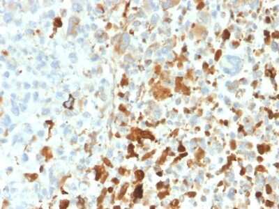 Immunohistochemistry-Paraffin: Vimentin Antibody (VIM/1937R) - Azide and BSA Free [NBP3-08936] - Formalin-fixed, paraffin-embedded human melanoma stained with Vimentin Rabbit Recombinant Monoclonal Antibody (VIM/1937R).