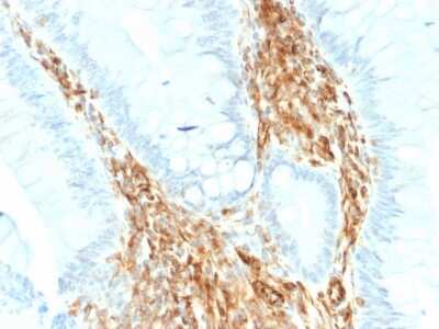 Immunohistochemistry-Paraffin: Vimentin Antibody (VIM/1937R) - Azide and BSA Free [NBP3-08936] - Formalin-fixed, paraffin-embedded human colon carcinoma stained with Vimentin Rabbit Recombinant Monoclonal Antibody (VIM/1937R).