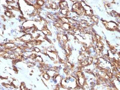 Immunohistochemistry-Paraffin: Vimentin Antibody (VM1170) - IHC-Prediluted [NBP2-48191] - Human Angiosarcoma stained with Vimentin Monoclonal Antibody (VM1170).