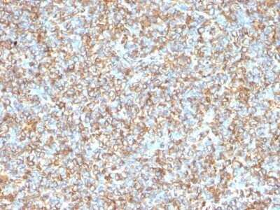 Immunohistochemistry-Paraffin: Vimentin Antibody (VM1170) - IHC-Prediluted [NBP2-48191] - Human Ewing's Sarcoma stained with Vimentin Monoclonal Antibody (VM1170).