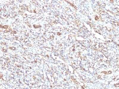 Immunohistochemistry-Paraffin: Vimentin Antibody (VM1170) - IHC-Prediluted [NBP2-48191] - Human Rhabdomyosarcoma stained with Vimentin Monoclonal Antibody (VM1170).