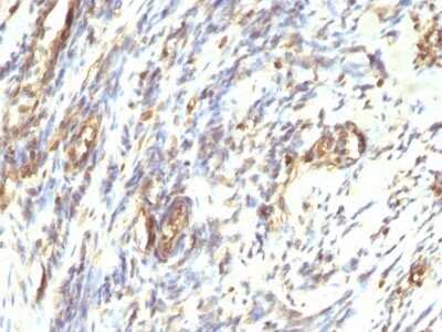 Immunohistochemistry-Paraffin: Vimentin Antibody (VM1170) - IHC-Prediluted [NBP2-48191] - Formalin-fixed, paraffin-embedded human Leiomyosarcoma stained with Vimentin Antibody (VM1170).