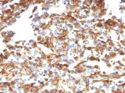 Immunohistochemistry-Paraffin: Vimentin Antibody (VM1170) - IHC-Prediluted [NBP2-48191] - Human Melanoma stained with Vimentin Monoclonal Antibody (VM1170).