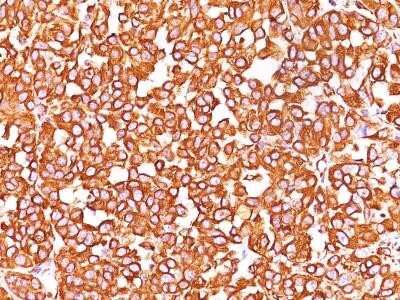 Immunohistochemistry-Paraffin: Vimentin Antibody (VM452) - Azide and BSA Free [NBP2-33060] - Formalin-paraffin human melanoma stained with Vimentin Ab (VM452).