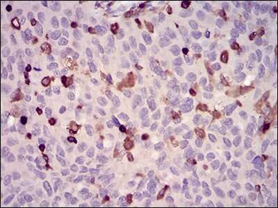 Immunohistochemistry-Paraffin: WASP Antibody (7B10E4) [NBP2-52587] - Analysis of paraffin-embedded ovarian cancer tissues using WAS mouse mAb with DAB staining.