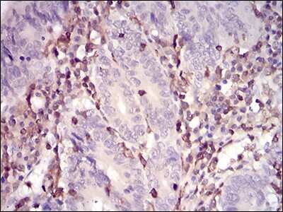 Immunohistochemistry-Paraffin: WASP Antibody (7B10E4) [NBP2-52587] - Analysis of paraffin-embedded colon cancer tissues using WAS mouse mAb with DAB staining.