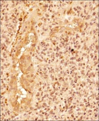 Immunohistochemistry-Paraffin: WDFY3 Antibody [NBP1-03332] - IHC analysis of a formalin fixed paraffin embedded tissue section of the human glioblastoma using 1:200 dilution of WDFY3 antibody (NBP1-03332). The signal was developed using HRP-DAB method which followed counterstaining of the cells with hematoxylin