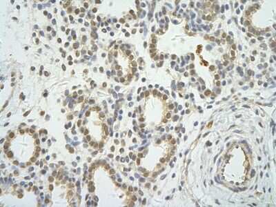 Immunohistochemistry: WDR12 Antibody [NBP1-53111] - Human Lung cell Cellular data: alveolar cell Antibody Concentration: 4.0-8.0 ug/ml Magnification: 400X.