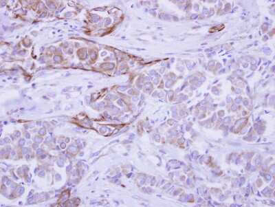 Immunohistochemistry-Paraffin: WDR49 Antibody [NBP2-20894] - Immunohistochemical analysis of paraffin-embedded Breast ca, using antibody at 1:500 dilution.