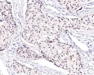 Immunohistochemistry-Paraffin: WDR5 Antibody (JM73-53) [NBP2-75711] - Analysis of paraffin-embedded human breast carcinoma tissue using anti-WDR5 antibody. The section was pre-treated using heat mediated antigen retrieval with sodium citrate buffer (pH 6.0) for 20 minutes. The tissues were blocked in 1% BSA for 30 minutes at room temperature, washed with ddH2O and PBS, and then probed with the primary antibody (1/200) for 30 minutes at room temperature. The detection was performed using an HRP conjugated compact polymer system. DAB was used as the chromogen. Tissues were counterstained with hematoxylin and mounted with DPX.