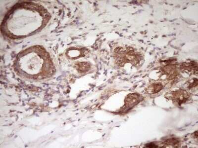Immunohistochemistry: WDR61 Antibody (OTI4C4) - Azide and BSA Free [NBP2-74866] - Analysis of Carcinoma of Human kidney tissue. (Heat-induced epitope retrieval by 1 mM EDTA in 10mM Tris, pH8.5, 120C for 3min)