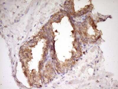 Immunohistochemistry: WDR61 Antibody (OTI4C4) - Azide and BSA Free [NBP2-74866] - Analysis of Carcinoma of Human prostate tissue. (Heat-induced epitope retrieval by 1 mM EDTA in 10mM Tris, pH8.5, 120C for 3min)