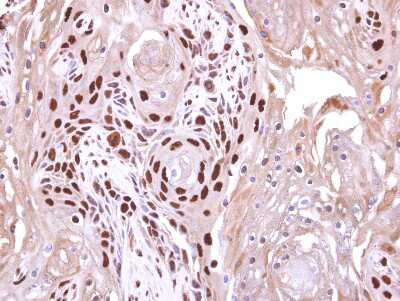 Immunohistochemistry-Paraffin: WDR62 Antibody [NBP2-20897] - Wdr62 antibody detects Wdr62 protein at nucleus on Ca922 oral cancer xenograft by immunohistochemical analysis. Sample: Paraffin-embedded Ca922 oral cancer xenograft. Wdr62 antibody dilution: 1:500.