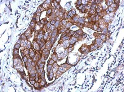 Immunohistochemistry-Paraffin: WDR65 Antibody [NBP2-20898] - Immunohistochemical analysis of paraffin-embedded BREAST CA, using antibody at 1:500 dilution.