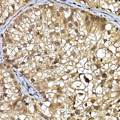 Immunohistochemistry-Paraffin: WDR68 Antibody [NBP2-95210] - Immunohistochemistry of paraffin-embedded human lung cancer using WDR68 Rabbit pAb (NBP2-95210) at dilution of 1:150 (40x lens). Perform high pressure antigen retrieval with 10 mM citrate buffer pH 6.0 before commencing with IHC staining protocol.