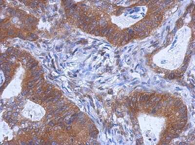 Immunohistochemistry-Paraffin: WDR85 Antibody [NBP2-20902] - Immunohistochemical analysis of paraffin-embedded Gastric ca, using antibody at 1:500 dilution.