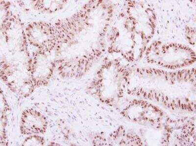 Immunohistochemistry-Paraffin: WDR91 Antibody [NBP2-20903] - Paraffin-embedded colon carcinoma. WDR91 antibody [N1N2], N-term dilution: 1:250.