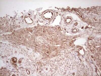 Immunohistochemistry: WIBG Antibody (OTI5E2) - Azide and BSA Free [NBP2-74868] - Analysis of Adenocarcinoma of Human endometrium tissue. (Heat-induced epitope retrieval by 1 mM EDTA in 10mM Tris, pH8.5, 120C for 3min)