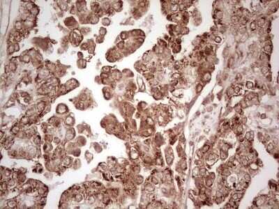 Immunohistochemistry: WIBG Antibody (OTI5E2) - Azide and BSA Free [NBP2-74868] - Analysis of Adenocarcinoma of Human ovary tissue. (Heat-induced epitope retrieval by 1 mM EDTA in 10mM Tris, pH8.5, 120C for 3min)