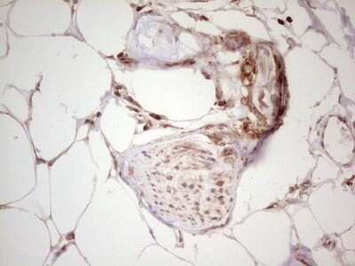 Immunohistochemistry: WIBG Antibody (OTI5E2) - Azide and BSA Free [NBP2-74868] - Analysis of Carcinoma of Human kidney tissue. (Heat-induced epitope retrieval by 1 mM EDTA in 10mM Tris, pH8.5, 120C for 3min)