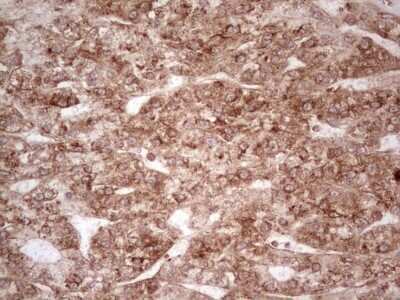 Immunohistochemistry: WIBG Antibody (OTI5E2) - Azide and BSA Free [NBP2-74868] - Analysis of Carcinoma of Human liver tissue. (Heat-induced epitope retrieval by 1 mM EDTA in 10mM Tris, pH8.5, 120C for 3min)