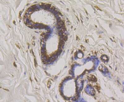 Immunohistochemistry-Paraffin: WNK1 Antibody (JG36-91) [NBP2-75712] - Analysis of paraffin-embedded human breast cancer tissue using anti-WNK1 antibody. Counter stained with hematoxylin.
