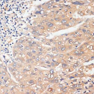 Immunohistochemistry-Paraffin: WNK3 Antibody [NBP2-94269] - Human liver cancer using WNK3 antibody at dilution of 1:100 (40x lens).