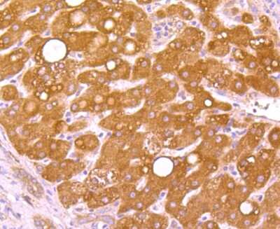 Immunohistochemistry-Paraffin: WSCD2 Antibody (9-F3) [NBP2-75715] - Analysis of paraffin-embedded human liver cancer tissue using anti-WSCD2 antibody. Counter stained with hematoxylin.