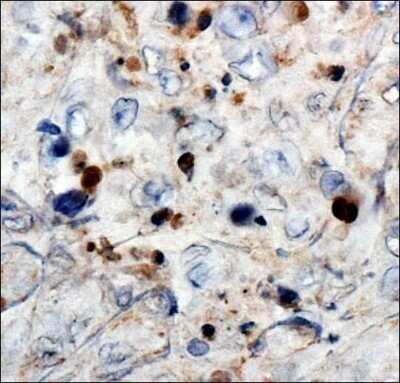 Immunohistochemistry: WT1 Antibody (6F-H2) - Azide and BSA Free [NBP2-81012] - Analysis of Wilms Tumor 1 in human renal cancer using DAB with hematoxylin counterstain. Image from the standard format of this antibody.