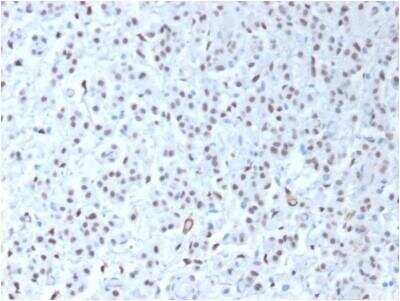 Immunohistochemistry-Paraffin: WT1 Antibody (WT1/1434R) - Azide and BSA Free [NBP3-11622] - Formalin-fixed, paraffin-embedded human Mesothelioma stained with WT1 Antibody (WT1/1434R).