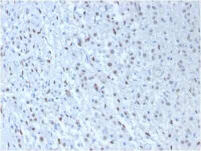 Immunohistochemistry-Paraffin: WT1 Antibody (WT1/857 + 6F-H2) - Azide and BSA Free [NBP2-47858] - Formalin-fixed, paraffin-embedded human Mesothelioma stained with WT1 Antibody (WT1/857 + 6F-H2).