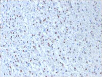 Immunohistochemistry-Paraffin: WT1 Antibody (WT1/857 + 6F-H2) - IHC-Prediluted [NBP2-48223] - Formalin-fixed, paraffin-embedded human Mesothelioma stained with Wilm's TumorMonoclonal Antibody (WT1/857 + 6F-H2).