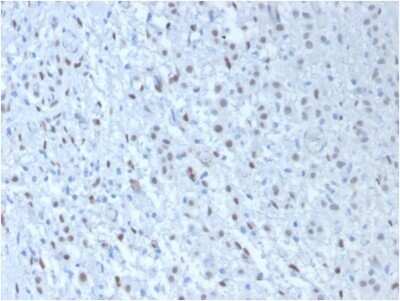 Immunohistochemistry-Paraffin: WT1 Antibody (WT1/857 + 6F-H2) - IHC-Prediluted [NBP2-48223] - Formalin-fixed, paraffin-embedded human Mesothelioma stained with WT1 Antibody (WT1/857 + 6F-H2).