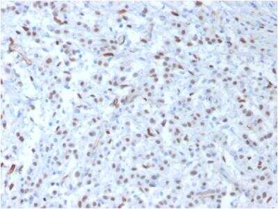 Immunohistochemistry-Paraffin: WT1 Antibody (WT1/857) - Azide and BSA Free [NBP2-47931] - Human Mesothelioma stained with Wilm's Tumor Mouse Monoclonal Antibody (WT1/857).