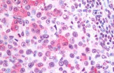 Immunohistochemistry-Paraffin: Wnt-10a Antibody - BSA Free [NB100-59026] - Immunohistochemical analysis of human melanoma in lymph node.