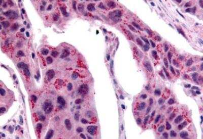 Immunohistochemistry-Paraffin: Wnt-2b Antibody [NB110-55622] - Human Breast, Carcinoma formalin-fixed, paraffin-embedded tissue after heat-induced antigen retrieval.