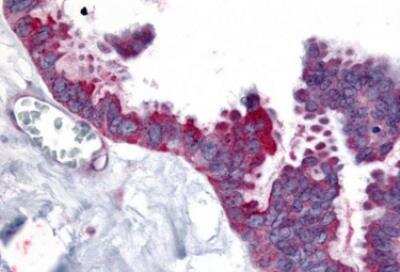 Immunohistochemistry-Paraffin: Wnt-2b Antibody [NB110-55622] - Human Ovary, Carcinoma formalin-fixed  paraffin-embedded tissue after heat-induced antigen retrieval.