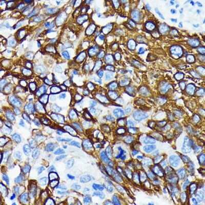 Immunohistochemistry-Paraffin: Wnt-5a Antibody (3P2E8) [NBP3-15684] - Immunohistochemistry of paraffin-embedded human lung cancer using Wnt-5a Rabbit mAb (NBP3-15684) at dilution of 1:100 (40x lens).Perform microwave antigen retrieval with 10 mM PBS buffer pH 7.2 before commencing with IHC staining protocol.