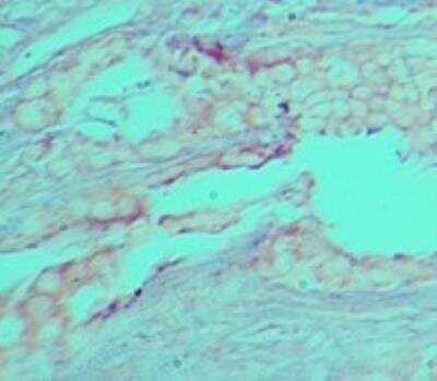 Immunohistochemistry-Paraffin: Wnt-5a Antibody (4M5E4) [NBP2-27295] - Staining of human breast tumor tissue probed with Wnt-5a antibody at 5 ug/ml.
