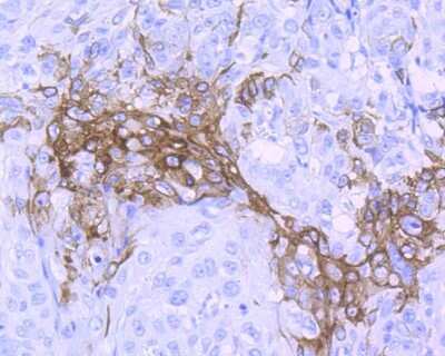 Immunohistochemistry-Paraffin: Wnt-5a Antibody (JU30-30) [NBP2-75714] - Analysis of paraffin-embedded human lung cancer tissue using anti-Wnt5a antibody. Counter stained with hematoxylin.