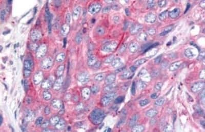 Immunohistochemistry: Wnt-8a Antibody [NBP3-14523] - Immunohistochemistry of colona carcinoma