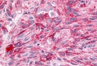 Immunohistochemistry-Paraffin: Wnt-8a Antibody [NBP3-14523] - Immunohistochemistry of formalin-fixed, paraffin-embedded human skin, melanoma, after heat-induced antigen retrieval.